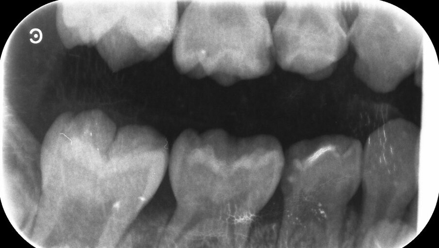 Afbeelding 5a. Bitewings bij intake.