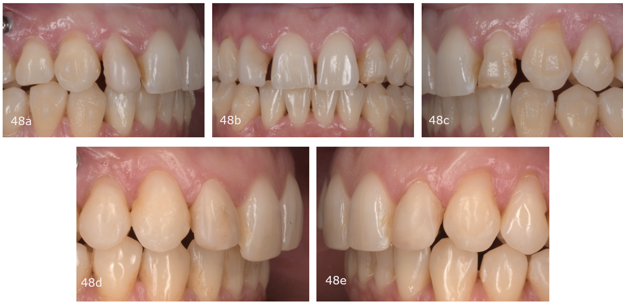 Figs. 48a–e: (a–c) Lateral incisors before and (d & e) after provisional composite restoration.