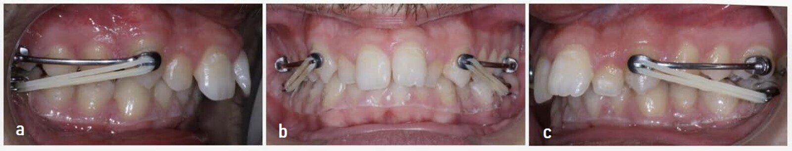 Figs. 9a–c: Class II Carriere Motion Appliance placed in the maxillary arch, buttons on teeth #36 and 46, and Essix-type transparent retainer. 