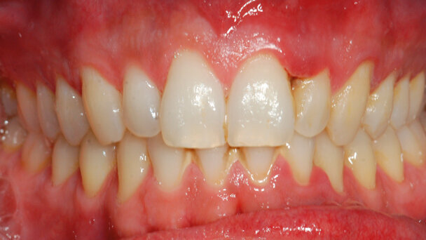 Gestione multidisciplinare del paziente affetto da gengivite ulcero-necrotica