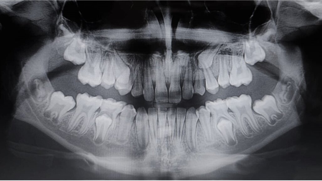 Management ortodontico delle trasposizioni dentali