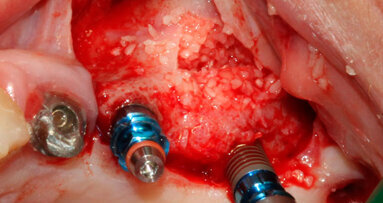 Rialzo di seno mascellare per via laterale  con l’utilizzo di PRGF®-Endoret® e di Hypro-Oss®