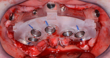 Full-arch CBCT-guided implant rehabilitation