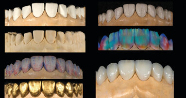 Flux de travail analogique vs. flux de travail numérique sur dix facettes maxillaires en céramique