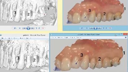 Προσωρινή αποκατάσταση με πλήρως ψηφιακή ροή