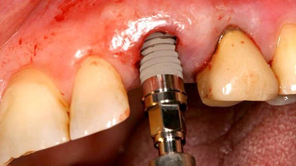 Операциите без ламбо и защо все още не трябва да се смятат за рутинен протокол