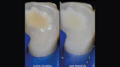 Sbiancamento dentale in età adolescenziale: approccio clinico minimamente invasivo grazie alle nuove formulazioni domiciliari Blancone