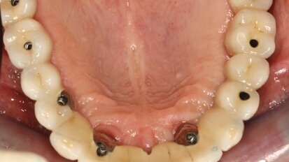 Guides chirurgicaux en implantologie : indications et limites