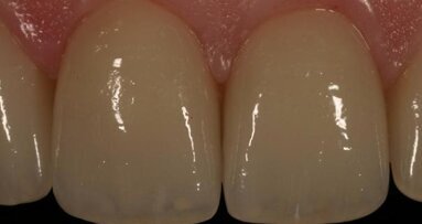 Lithium disilicate, the restorative material of multiple options