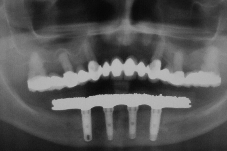 Fig. 26. Rx Pre-operatoria, Prótesis híbrida inmediata con 8 años de evolución y Rx Control a los 8 años.
