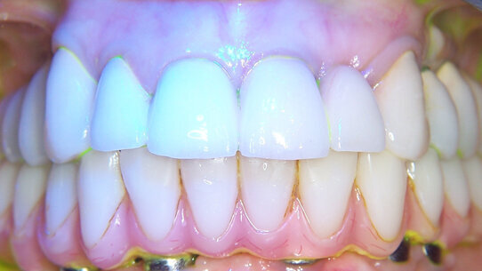 Utilizzo della terapia fotodinamica Helbo nel trattamento delle perimplantiti: case report