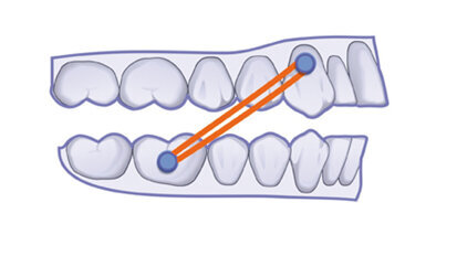 El protocolo clínico CA® CLEAR-ALIGNER y por qué es así