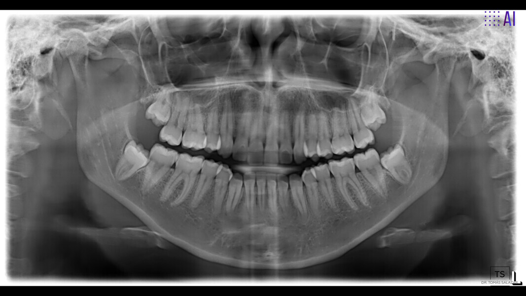 Fig. 5: Dental panoramic tomogram.