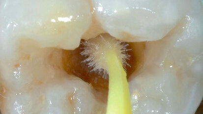 Výměna defektní distální výplně