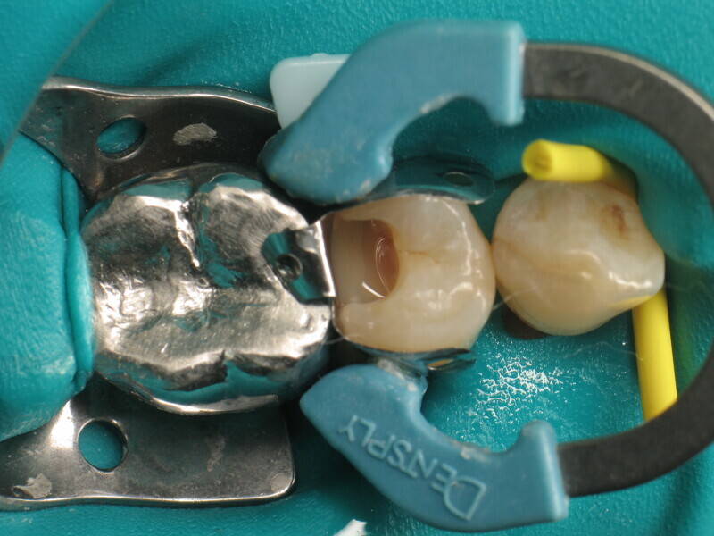 Fig. 10 : Fond de cavité remplie avec du GrandioSO Light Flow.