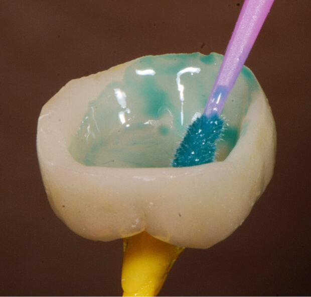 Fig. 5: Etching and silanating with Monobond Etch & Prime