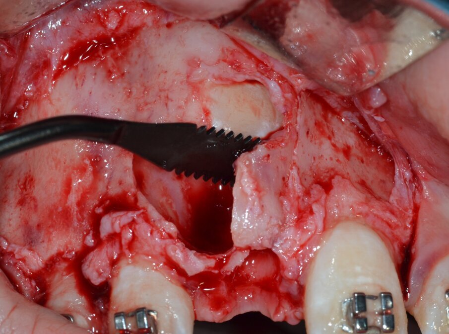 Fig. 14_Esecuzione dell’alveolectomia conduttrice mediante inserto piezoelettrico.