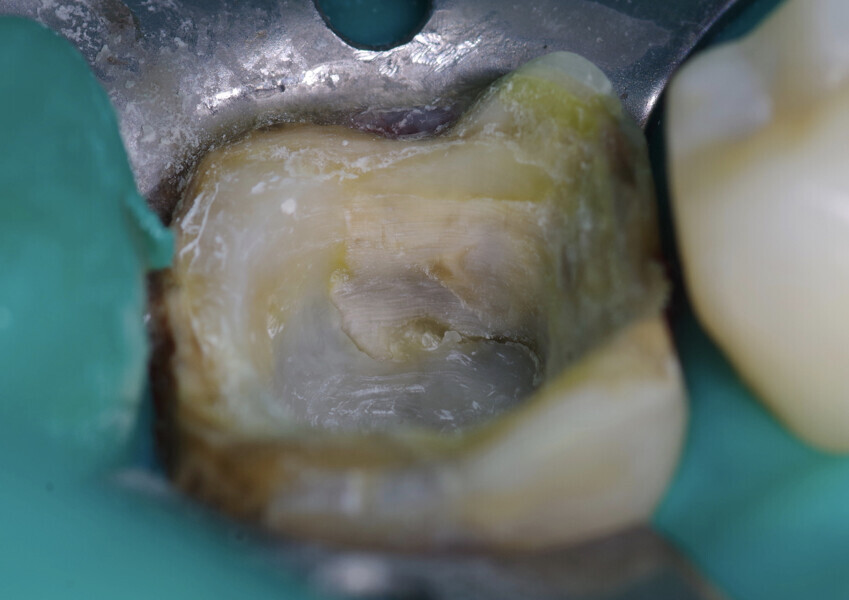 Fig. 10: Cavity shaped, excess material removed and margins smoothed.