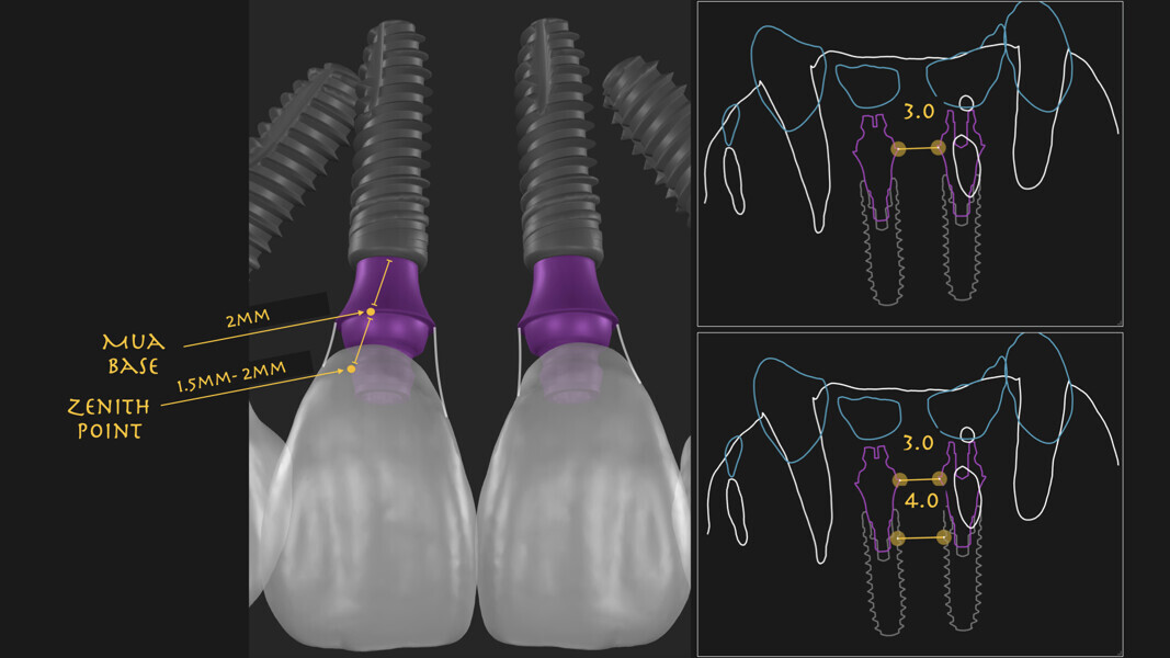 Fig. 11: Planning the implants in relation to the future gingival zenith and considering the space between the implant components. MUA = multi-unit abutment. 
