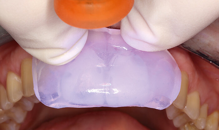 Fig. 3: With a transparent silicone key and light-curing composite, the mock-up was fabricated intraorally.