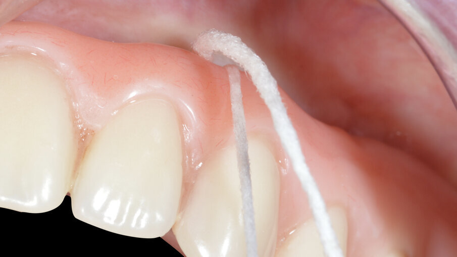 Fig. 17_Manovre di igiene professionale per la pulizia degli ancoraggi implantari.