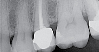 Problematika kalcifikovaných kanálků, kazuistika