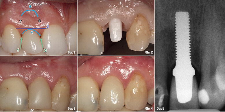 Případ 1: Implantát Z5m byl zaveden do oblasti zubu 22. Bylo dosaženo velké spokojenosti pacienta.