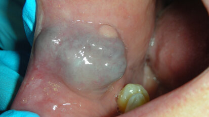 Il trattamento micro-invasivo degli emangiomi orali effettuato con laser a diodi: due case report