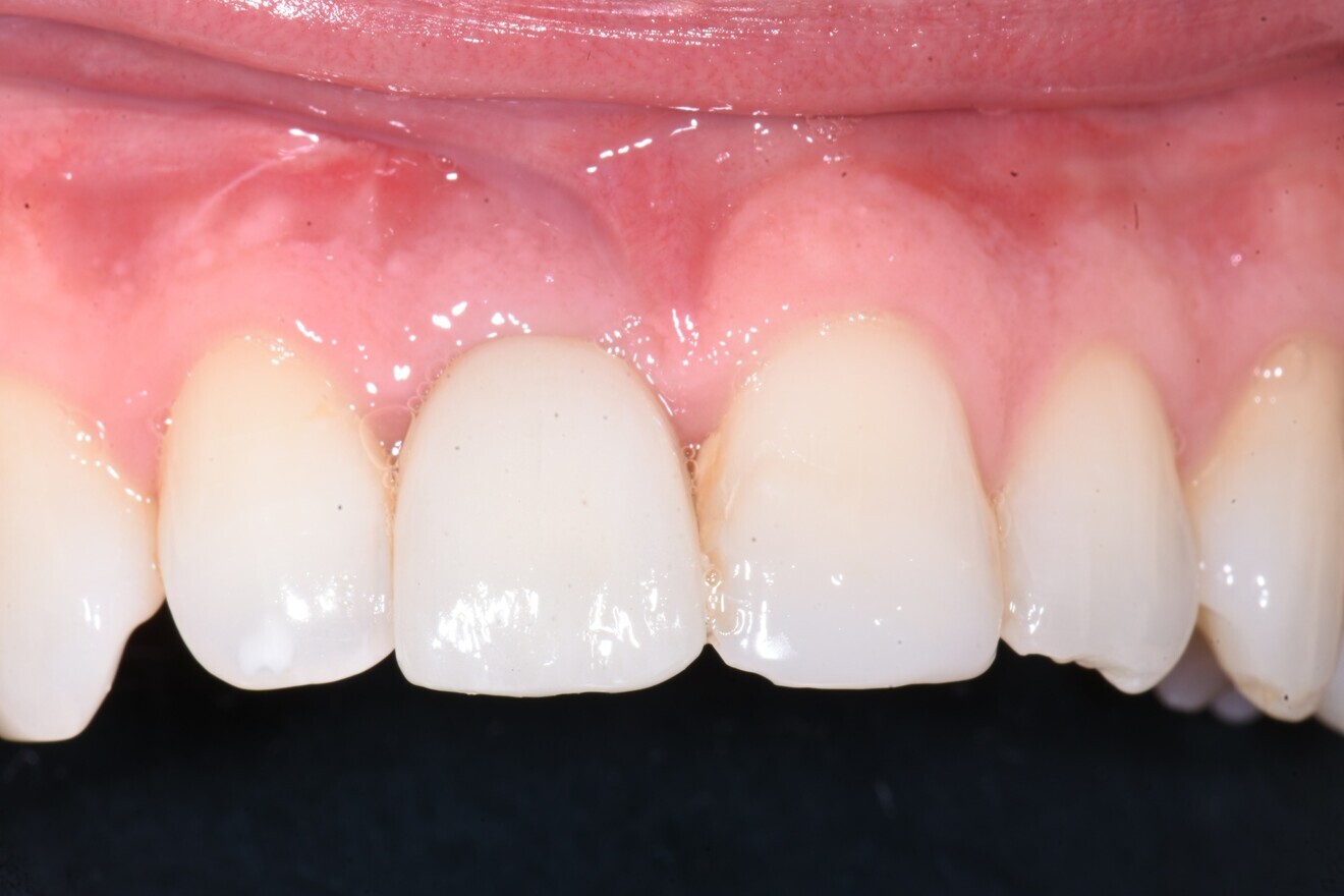 Fig. 12: Definitive screw-retained zirconia crown on an Atlantis CustomBase milled titanium abutment. 