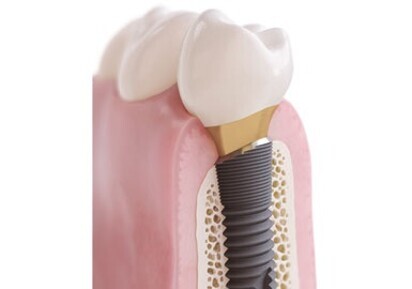 Dentsply Sirona – OsseoSpeed Profile EV