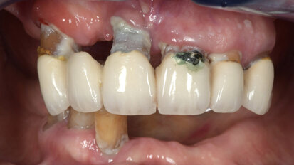 Traitement implantaire du patient édenté – Apport des techniques numériques