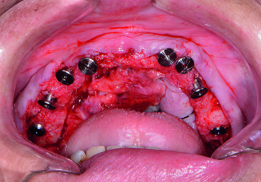 Fig. 12: Healing caps placed.