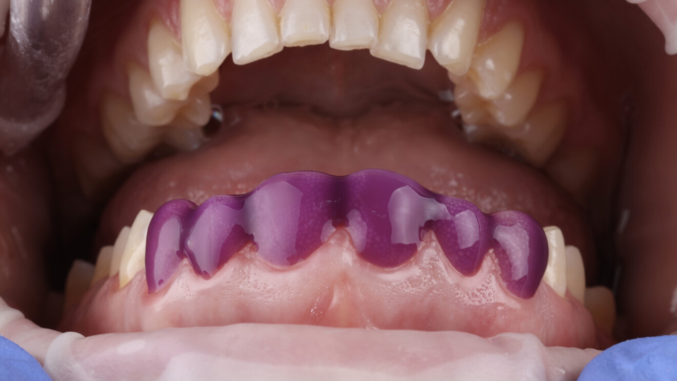 Fig. 6a: Tooth surface preparation before adhesive cementation. Acid etching of the enamel.