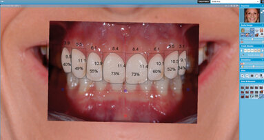 Applicazione di un software per smile design e CAD/CAM per la realizzazione del mock-up e dei restauri definitivi