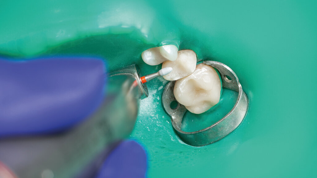 Protection du patient en odontologie – Le cadre à digue de seconde génération