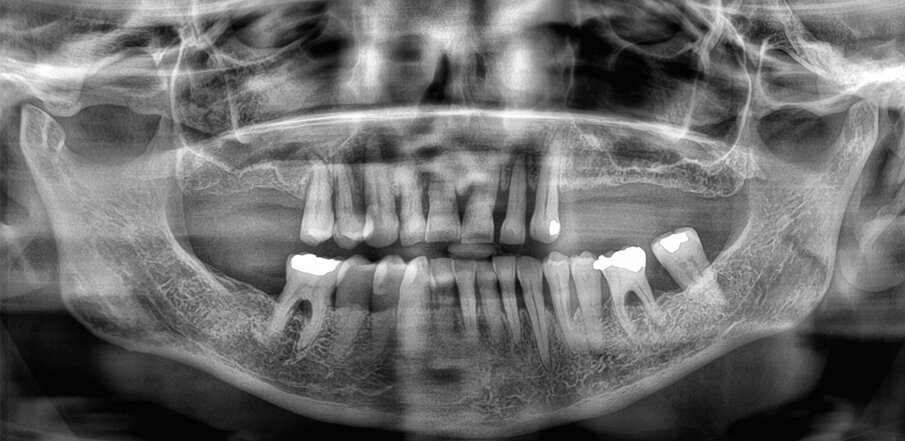Obr. 1: Předoperační rentgenový snímek.
