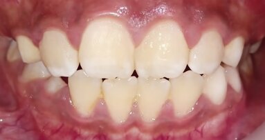 El Síndrome Periodontal No Carioso