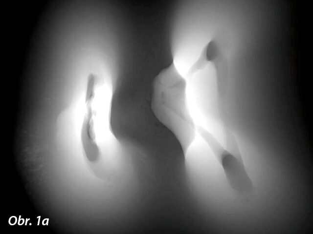 Tento axiální pohled na dolní molár demonstruje ovoidní excentricitu kanálků a existenci jistého spojení mezi meziobukálním a meziolingválním kanálkem v souladu s nálezy četných  studií.