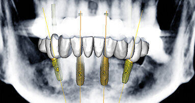 Rekonstrukce chrupu v dolní čelisti