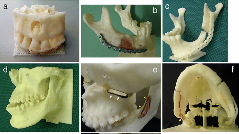 Des chercheurs développent un cadre propice à la fabrication de modèles dentaires 3D à faible coût