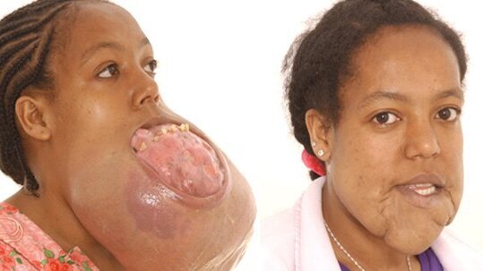 Neues Gesicht: Ärzte entfernen Riesen-Tumor