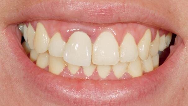 Implantacja natychmiastowa Ankylos® C/X