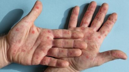 Een praktijk zonder apenpokken