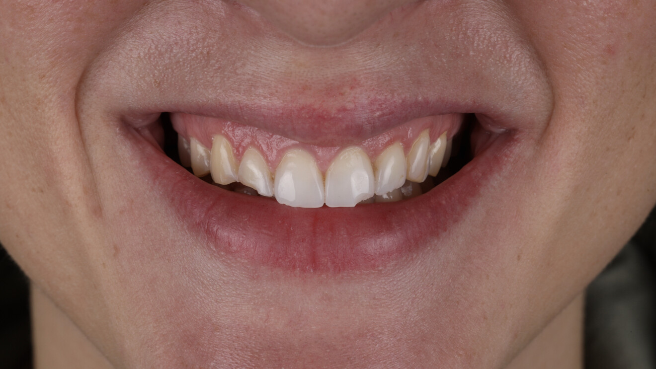 Fig. 1b: Preoperative view of the maxillary anterior restorations. Extra-oral close-up smile view showing the aged composite veneers.