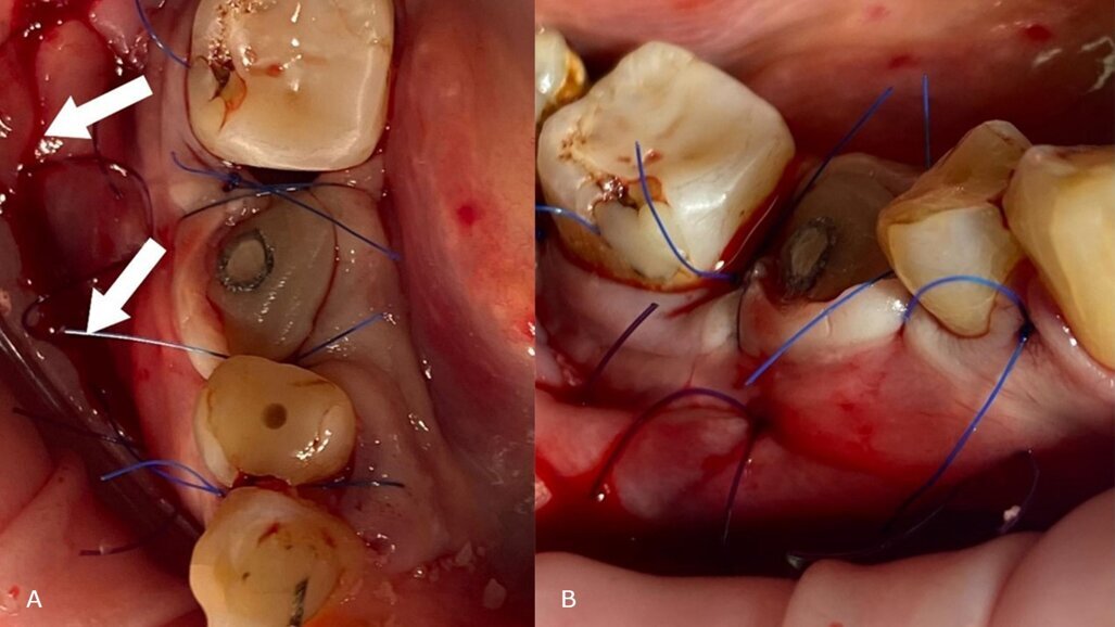 Poncho Lamina Technique: un nuovo approccio in un solo passaggio per l’aumento simultaneo del tessuto duro e molle in singoli siti implantari con atrofia ossea