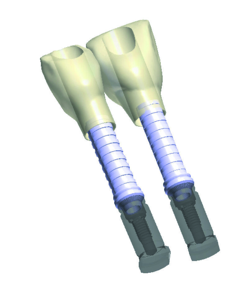 Figs. 6a et b : Réalisation d’un trou en face palatine des couronnes provisoires, permettant le rebasage au fauteuil. Notez la facilité d’insertion des couronnes à travers les piliers provisoires.