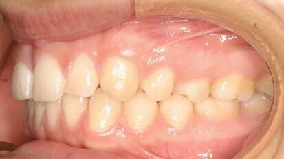 Posibilidades terapéuticas del Clear-Aligner