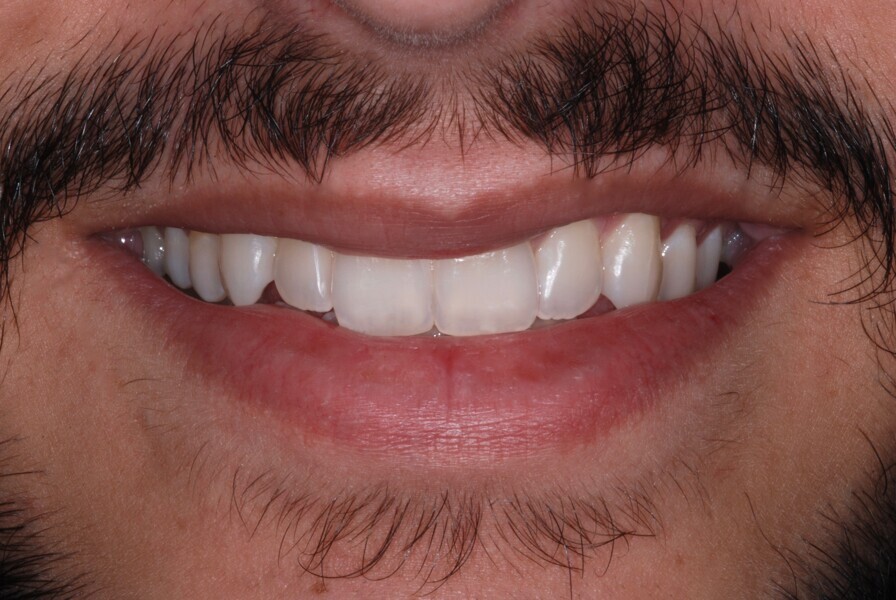 Fig. 28: Smile frontal view after treatment.