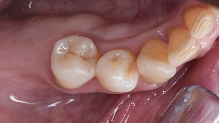 Figg. 1a-1c_Foto clinica e sezioni di CBCT iniziali in cui si evidenzia edentulia distale all’elemento 4.5 con atrofia tridimensionale.