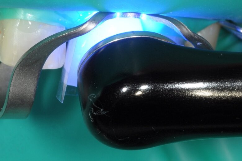 Fig. 22 Light-activated polymerization (minimum of 10 seconds).